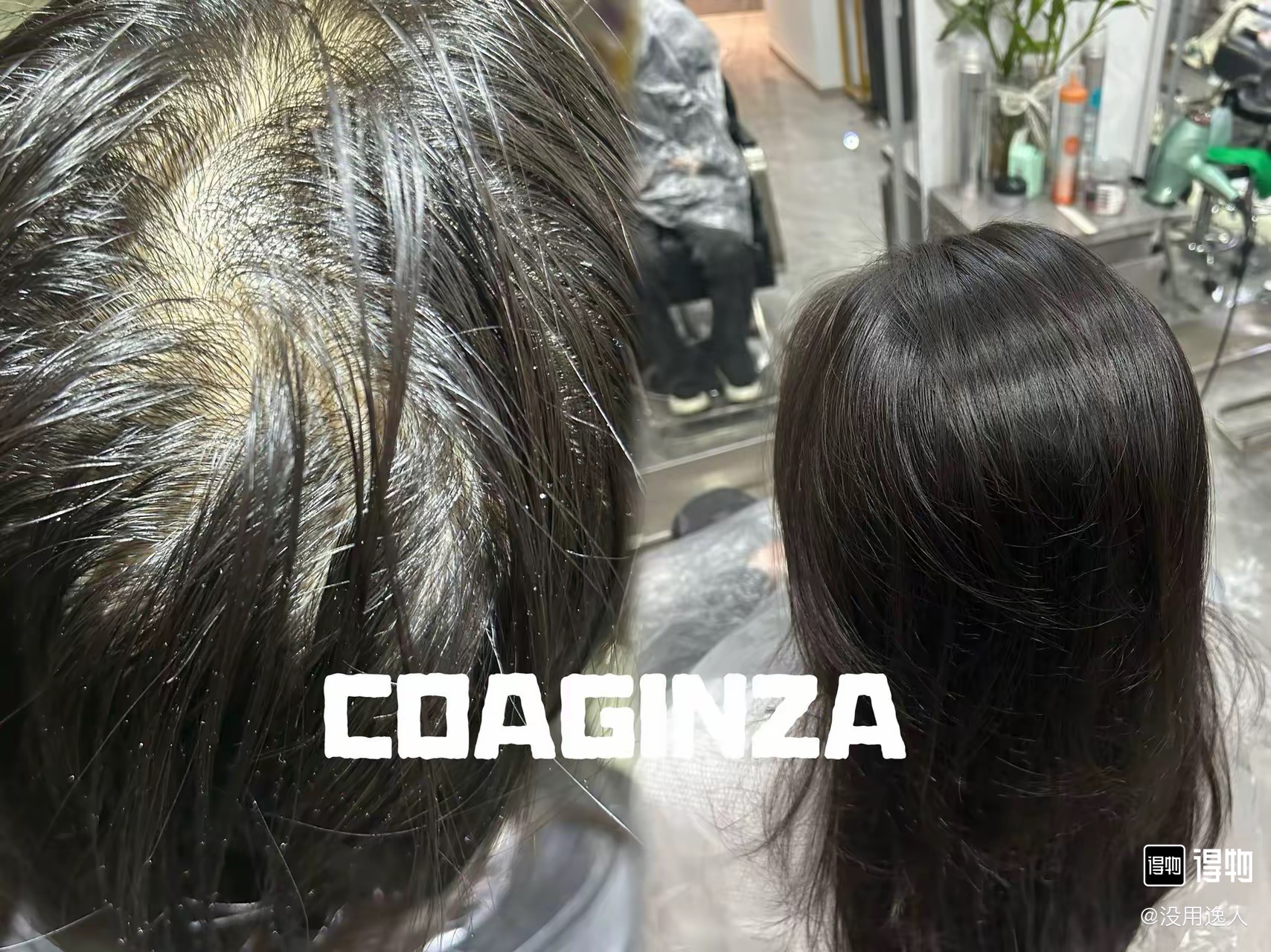 发缝消失术效果展示